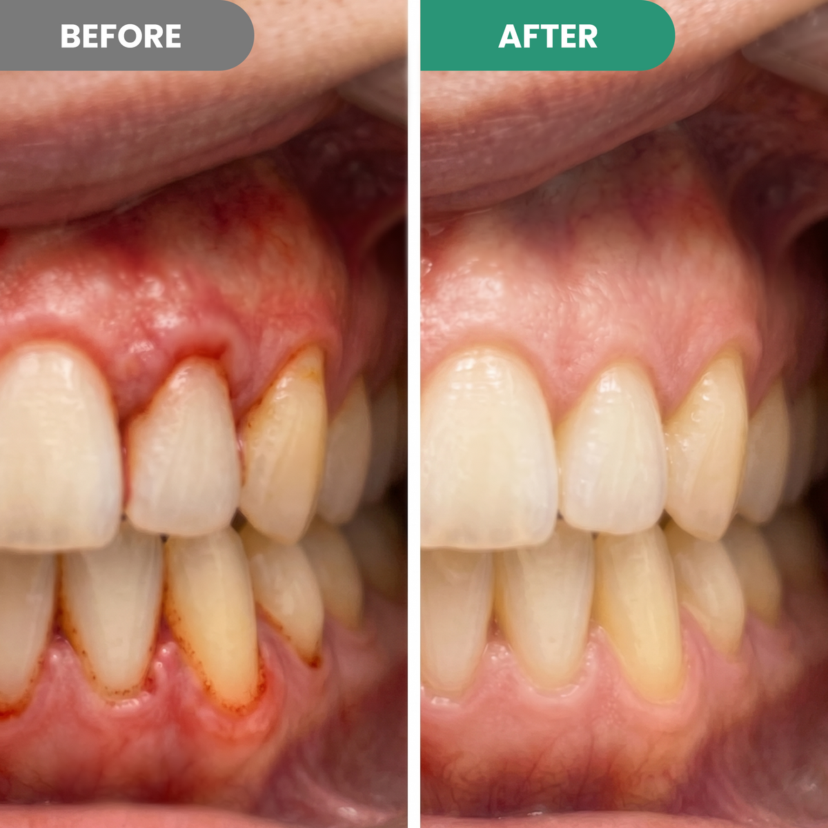 Gum Repair Pen - Stronger teeth