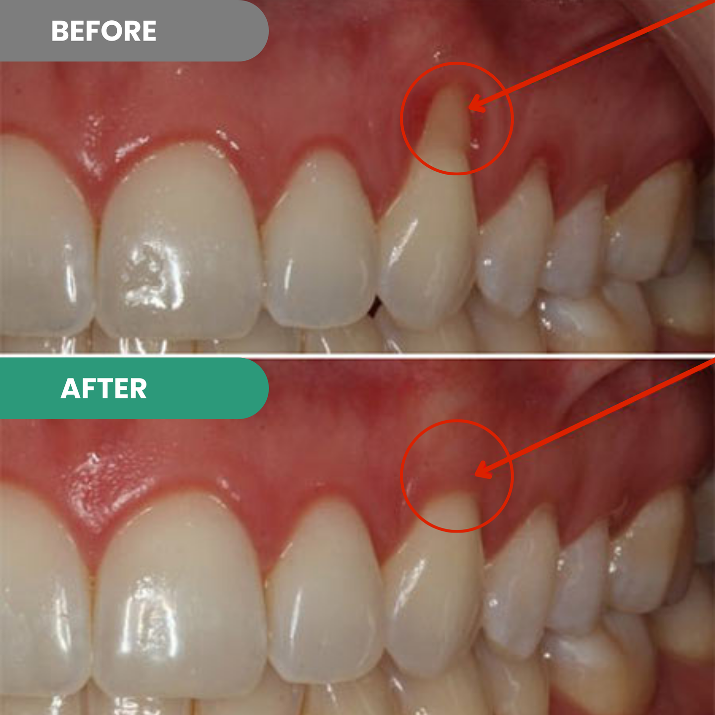Gel de réparation des dents