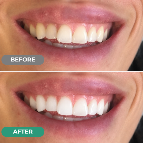 Peroxide-Free Whitening Strips